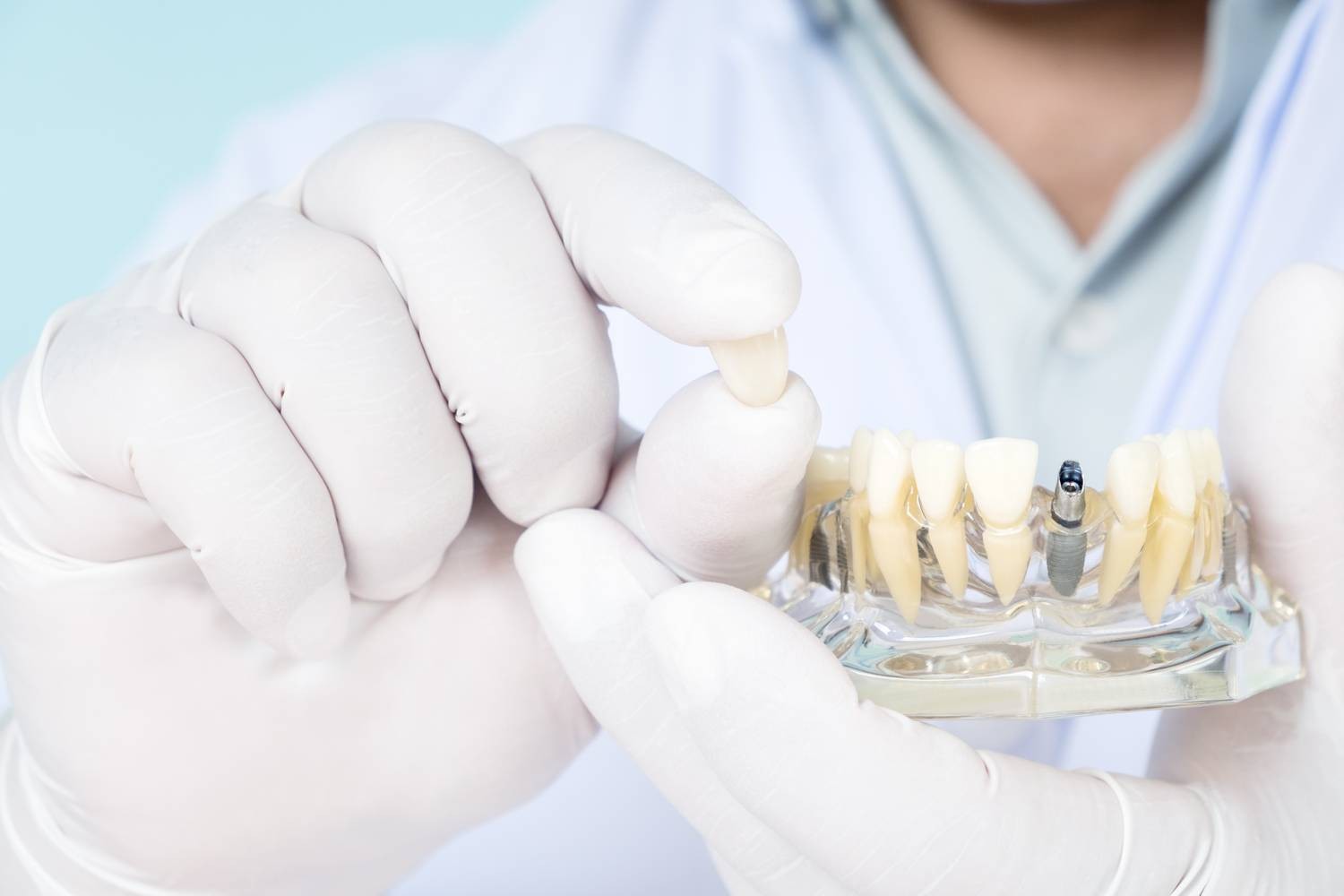 Implanty dentystyczne – czy mogą zastąpić prawdziwe zęby?