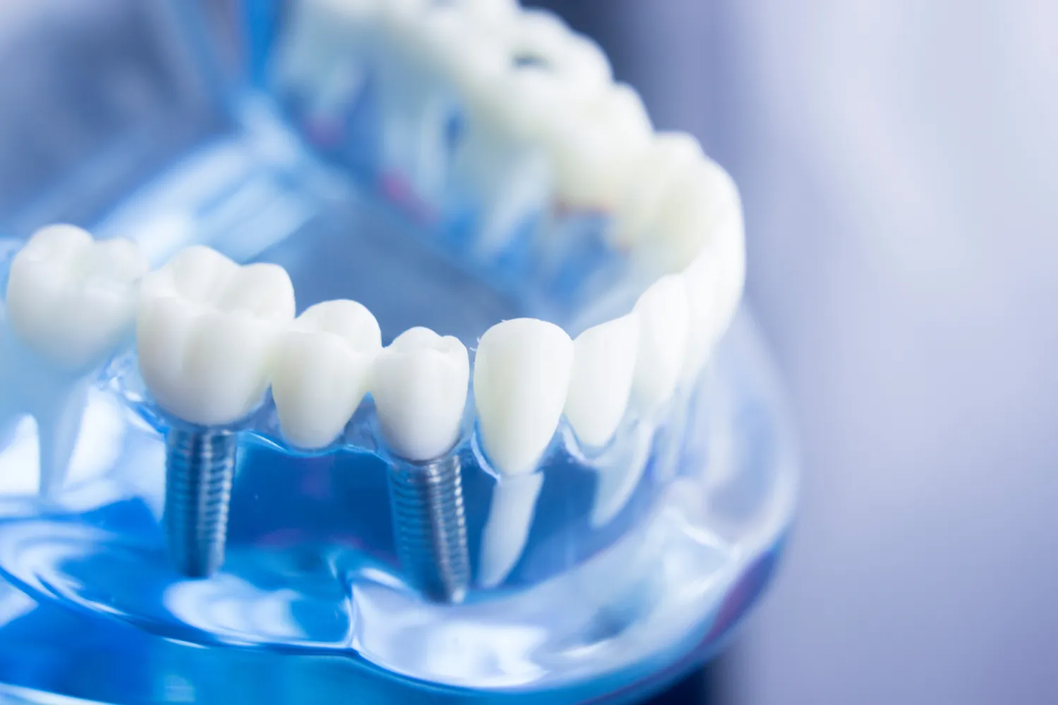 Rodzaje implantów zębowych