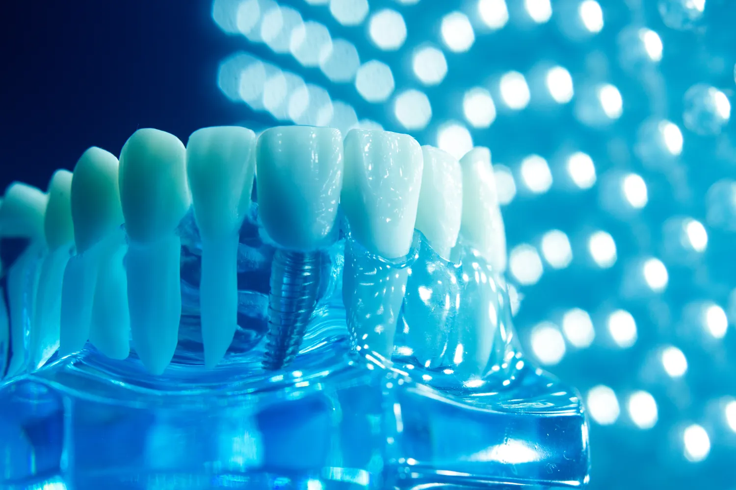 Leczenie kanałowe Poznań gdzie najlepiej