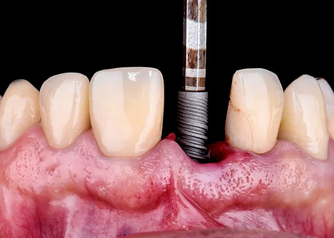 Leczenie kanałowe Wrocław gdzie najlepiej