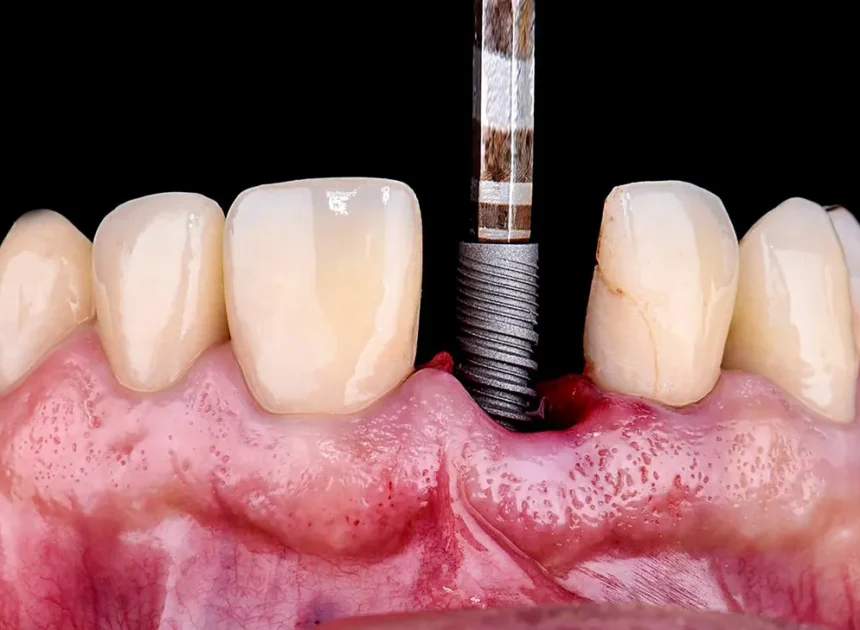 Leczenie kanałowe Wrocław gdzie najlepiej