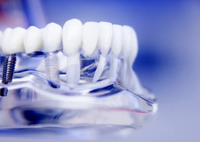 Najlepsze nakładki ortodontyczne Warszawa