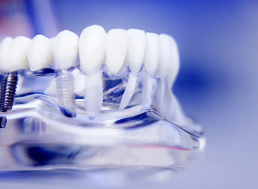 Najlepsze nakładki ortodontyczne Warszawa