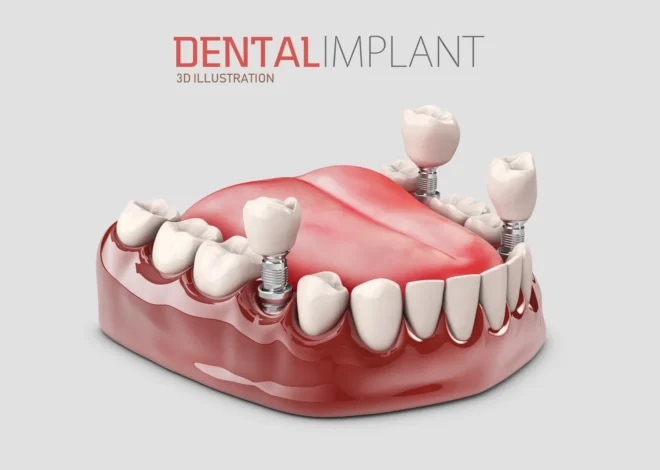 Co ile wymienia się implanty zębów?