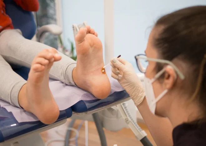 Co ile zamrażać kurzajki?