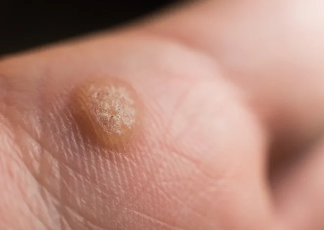 Co na kurzajki domowe sposoby?