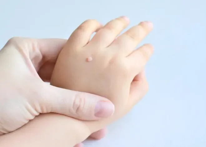 Co na kurzajki i brodawki?