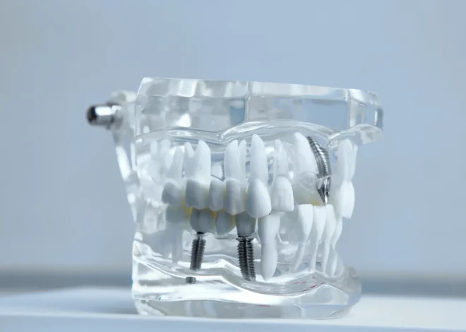 Implanty zębowe Warszawa gdzie najlepiej?