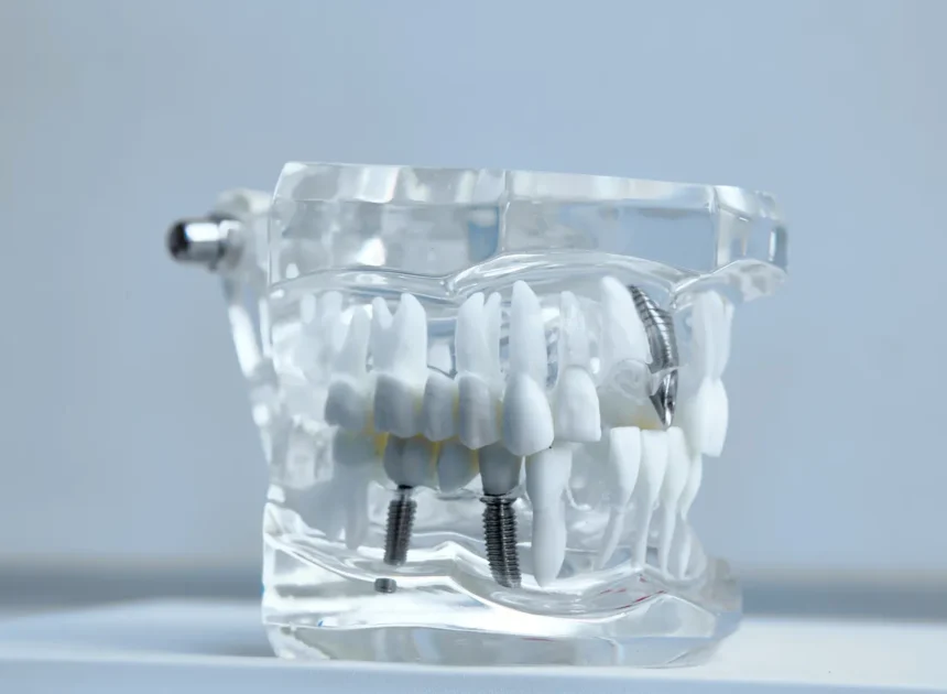 Implanty zębowe Warszawa gdzie najlepiej?