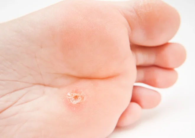 Ile kosztuje wycięcie kurzajki?