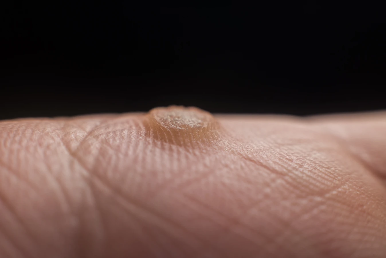 Ile trwa leczenie kurzajki?