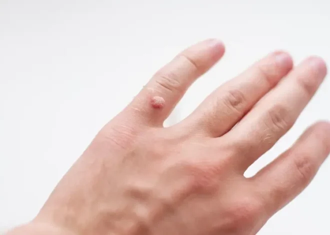 Jaskółcze ziele na kurzajki jak zrobić?